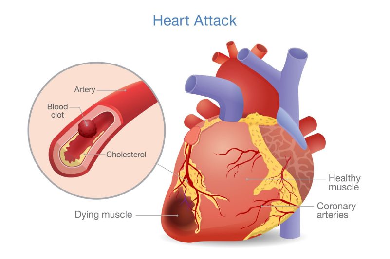 How a heart attack can cause arm pain after sneezing