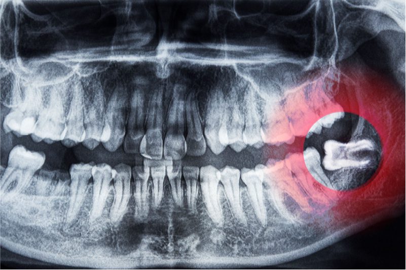 Pros and Cons of Wisdom Teeth Removal