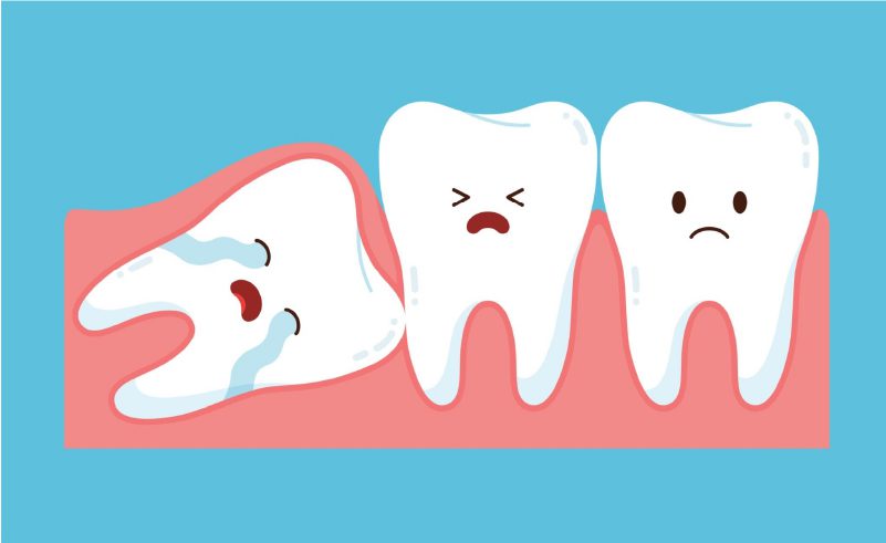 Risks and Complications of Wisdom Teeth Removal